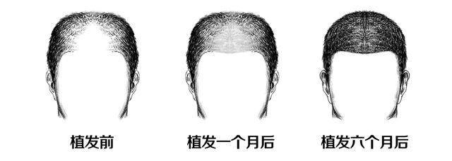植发,毛发移植,