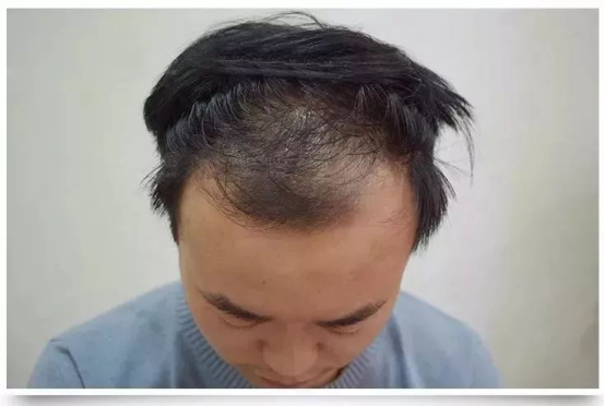 SFT技术,
