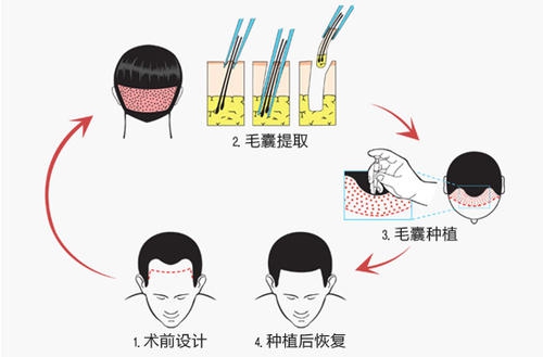 毛发移植医生,